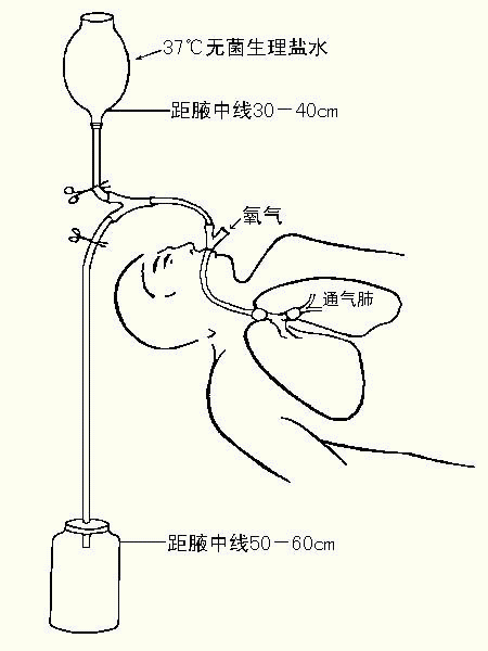 尘肺灌洗治疗科特色疗法(图3)
